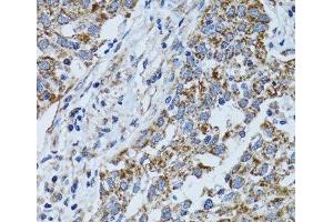 Immunohistochemistry of paraffin-embedded Human lung cancer using ATP5B Polyclonal Antibody at dilution of 1:100 (40x lens). (ATP5B antibody)