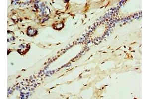 Immunohistochemistry of paraffin-embedded human breast cancer using ABIN7146290 at dilution of 1:100 (CALCB antibody  (AA 1-127))