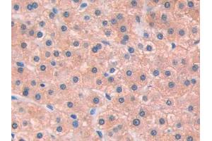 DAB staining on IHC-P; Samples: Human Liver cancer Tissue (IL13 Receptor alpha 1 antibody  (AA 203-376))