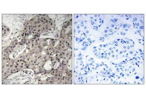 Immunohistochemistry analysis of paraffin-embedded human breast carcinoma tissue using RPL3 antibody. (RPL3 antibody  (Internal Region))
