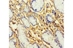 Immunohistochemistry of paraffin-embedded human gastric cancer using ABIN7164709 at dilution of 1:100 (Prokineticin Receptor 1 antibody  (AA 1-62))