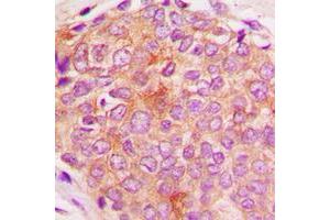 Immunohistochemical analysis of HSPE1 staining in human breast cancer formalin fixed paraffin embedded tissue section. (HSPE1 antibody  (Center))