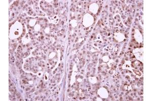 IHC-P Image Immunohistochemical analysis of paraffin-embedded NCIN87 xenograft, using RPB2, antibody at 1:500 dilution. (POLR2B antibody  (N-Term))