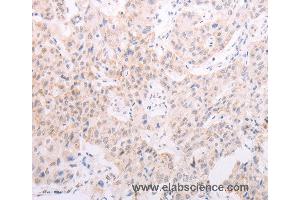 Immunohistochemistry of Human lung cancer using TYR Polyclonal Antibody at dilution of 1:30 (TYR antibody)