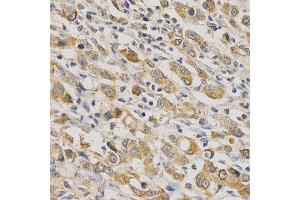 Immunohistochemistry of paraffin-embedded human stomach cancer using ERG antibody at dilution of 1:200 (x400 lens).