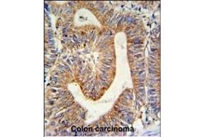 RPL17 Antibody (C-term) (ABIN653848 and ABIN2843111) IHC analysis in formalin fixed and paraffin embedded colon carcinoma followed by peroxidase conjugation of the secondary antibody and DAB staining. (RPL17 antibody  (C-Term))