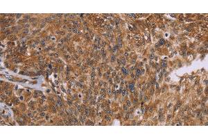 Immunohistochemistry of paraffin-embedded Human ovarian cancer using PPIB Polyclonal Antibody at dilution of 1:45 (PPIB antibody)