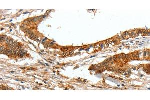 Immunohistochemistry of paraffin-embedded Human colon cancer tissue using COL1A2 Polyclonal Antibody at dilution 1:70 (COL1A2 antibody)