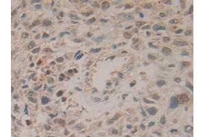 Detection of HPRT1 in Human Lung cancer Tissue using Polyclonal Antibody to Hypoxanthine Phosphoribosyltransferase 1 (HPRT1) (HPRT1 antibody  (AA 3-218))