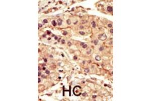 Immunohistochemistry (Paraffin-embedded Sections) (IHC (p)) image for anti-Src-Related Kinase Lacking C-Terminal Regulatory Tyrosine and N-Terminal Myristylation Sites (SRMS) (AA 456-485), (C-Term) antibody (ABIN392109)