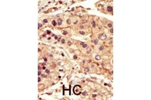 Formalin-fixed and paraffin-embedded human cancer tissue reacted with the primary antibody, which was peroxidase-conjugated to the secondary antibody, followed by DAB staining. (SRMS antibody  (C-Term))