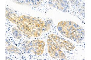 ABIN6255023 and ABIN6267139 at 1/100 staining Human esophageal cancer by IHC-P. (MFF antibody  (pSer146, pSer172))