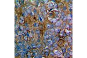 Immunohistochemical analysis of MKK1/2 staining in human prostate cancer formalin fixed paraffin embedded tissue section. (MEK1 antibody  (Center))