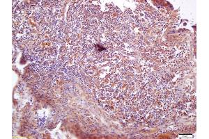 Formalin-fixed and paraffin embedded human lung carcinoma labeled with Anti-VAV3 Polyclonal Antibody, Unconjugated (ABIN706421) at 1:200 followed by conjugation to the secondary antibody and DAB staining (VAV3 antibody  (AA 701-800))