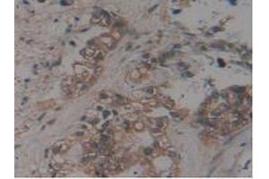 IHC-P analysis of Human Pancreas Cancer Tissue, with DAB staining. (MAPT antibody  (AA 130-386))
