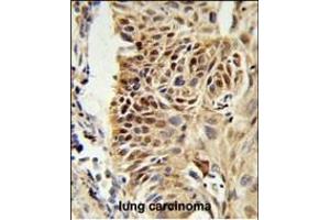 CIRBP Antibody (C-term) (ABIN653083 and ABIN2842680) IHC analysis in formalin fixed and paraffin embedded human lung carcinoma followed by peroxidase conjugation of the secondary antibody and DAB staining. (CIRBP antibody  (C-Term))