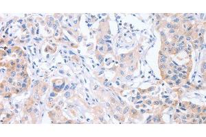 Immunohistochemistry of paraffin-embedded Human lung cancer tissue using CDCA4 Polyclonal Antibody at dilution 1:50 (CDCA4 antibody)