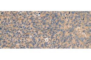 Immunohistochemistry of paraffin-embedded Human cervical cancer tissue using EIF1AX Polyclonal Antibody at dilution of 1:65(x200) (EIF1AX antibody)