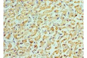 Immunohistochemistry of paraffin-embedded human liver cancer using ABIN7143181 at dilution of 1:100 (ACVR2A antibody  (AA 20-140))