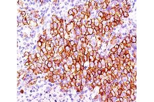 IHC testing of Hodgkin's lymphoma (20X) stained with CD30 antibody (CD30/412).