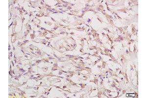 Formalin-fixed and paraffin embedded human cervical carcinoma labeled with Anti-Phospho-FGFR1+FGFR2 (Tyr463) Polyclonal Antibody, Unconjugated (ABIN758197) at 1:200 followed by conjugation to the secondary antibody and DAB staining (FGFR1/FGFR2 antibody  (pTyr463, pTyr466))