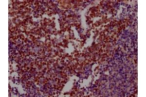 IHC image of ABIN7127596 diluted at 1:100 and staining in paraffin-embedded human lung cancer performed on a Leica BondTM system. (Recombinant XRCC5 antibody)