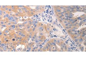 Immunohistochemistry of paraffin-embedded Human breast cancer tissue using CK-6A/B/C Polyclonal Antibody at dilution 1:50 (CK-6A/B/C antibody)