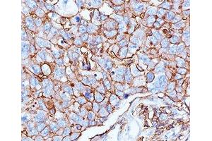 IHC testing of human breast cancer stained with HCAM antibody (156-3C11). (CD44 antibody)