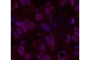 Immunofluorescence analysis of Human breast cancer tissue using Oct-1/2 Monoclonal Antibody at dilution of 1:200. (Oct-1/2 antibody)