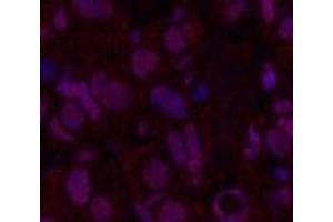 Immunofluorescence analysis of Human breast cancer tissue using Oct-1/2 Monoclonal Antibody at dilution of 1:200. (Oct-1/2 antibody)