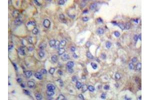 Immunohistochemistry analyzes of Flg antibody in paraffin-embedded human breast carcinoma tissue. (FGFR1 antibody)