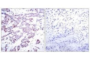 Immunohistochemical analysis of paraffin-embedded human breast carcinoma tissue using STAT6(Phospho-Thr645) Antibody(left) or the same antibody preincubated with blocking peptide(right). (STAT6 antibody  (pThr645))