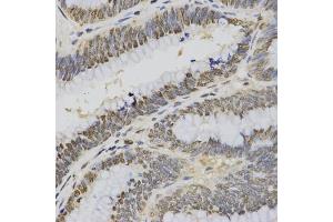 Immunohistochemistry of paraffin-embedded human rectal cancer using Trimethyl-Histone H3-K4 antibody (ABIN5969804) at dilution of 1/200 (40x lens). (Histone 3 antibody  (H3K4me3))