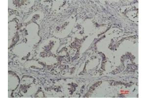 Immunohistochemical analysis of paraffin-embedded Human Breast Caricnoma using PhosphotyrosineMouse mAb diluted at 1:200. (Phosphotyrosine antibody)