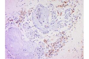 Formalin-fixed and paraffin embedded human larynocarcinoma labeled with Anti-CD20 Polyclonal Antibody, Unconjugated  at 1:200 followed by conjugation to the secondary antibody and DAB staining. (CD20 antibody  (AA 133-182))
