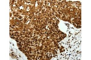 Immunohistochemical analysis of paraffin-embedded Human cervical cancer tissue using at dilution 1/40. (SCN11A antibody  (Internal Region))