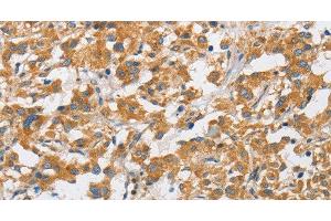 Immunohistochemistry of paraffin-embedded Human thyroid cancer using ARHGAP15 Polyclonal Antibody at dilution of 1:50 (ARHGAP15 antibody)