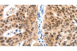 Immunohistochemistry of paraffin-embedded Human ovarian cancer tissue using LRP5 Polyclonal Antibody at dilution 1:115 (LRP5 antibody)