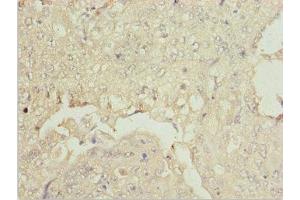 Immunohistochemistry of paraffin-embedded human lung cancer using ABIN7176007 at dilution of 1:100 (ZNF187 antibody  (AA 239-478))