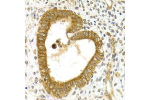 Immunohistochemistry of paraffin-embedded human adenomyosis using RAB27A antibody at dilution of 1:200 (400x lens).