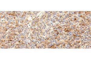 Immunohistochemistry of paraffin-embedded Human liver cancer using ZNF365 Polyclonal Antibody at dilution of 1/20 (ZNF365 antibody)