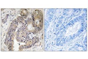 Immunohistochemistry analysis of paraffin-embedded human colon carcinoma tissue using CAD (Phospho-Thr456) antibody. (CAD antibody  (pThr456))