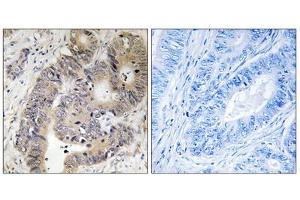 Immunohistochemistry analysis of paraffin-embedded human colon carcinoma tissue using CAD (Phospho-Thr456) antibody.