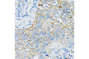 Immunohistochemistry of paraffin-embedded human lung cancer using CTNNA1 antibody (ABIN1876836) at dilution of 1:100 (40x lens). (CTNNA1 antibody)