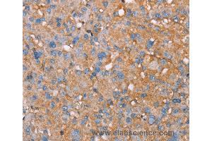 Immunohistochemistry of Human liver cancer using PAGE5 Polyclonal Antibody at dilution of 1:55