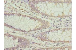 Immunohistochemistry of paraffin-embedded human colon cancer using ABIN7144377 at dilution of 1:100 (AP3B1 antibody  (AA 895-1094))