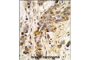 Formalin-fixed and paraffin-embedded human breast carcinoma tissue reacted with IARS2 antibody (Center) , which was peroxidase-conjugated to the secondary antibody, followed by DAB staining. (IARS2 antibody  (AA 600-628))