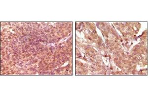 Immunohistochemical analysis of paraffin-embedded human bladder carcinoma (left) and breast carcinoma (right), showing nuclear and cytoplasmic localization using SRA mouse mAb with DAB staining.