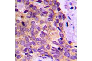 Immunohistochemical analysis of PRKAR1B staining in human breast cancer formalin fixed paraffin embedded tissue section.