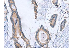 The image on the left is immunohistochemistry of paraffin-embedded Human colon cancer tissue using ABIN7189998(BOD1 Antibody) at dilution 1/30, on the right is treated with synthetic peptide.